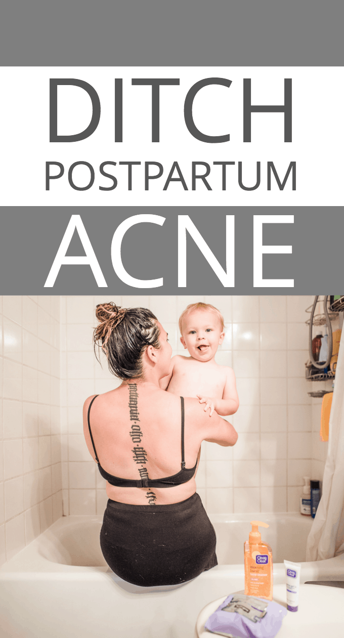 How to ditch postpartum acne (without seeing a dermatologist) – for good!